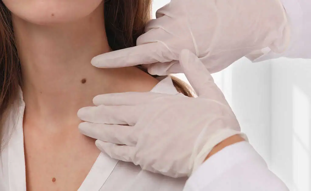 Skin Tag Removal by Laredo Wellness and Aesthetics in Laredo TX