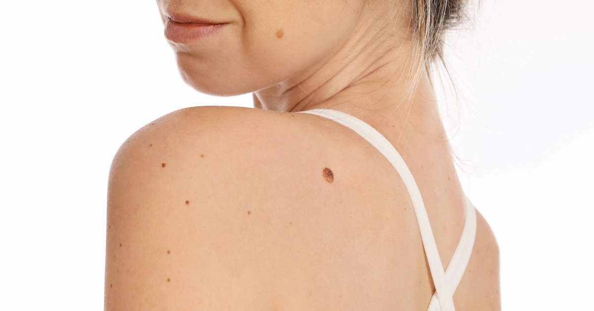 Skin tags and moles on a woman's shoulder in Laredo, TX