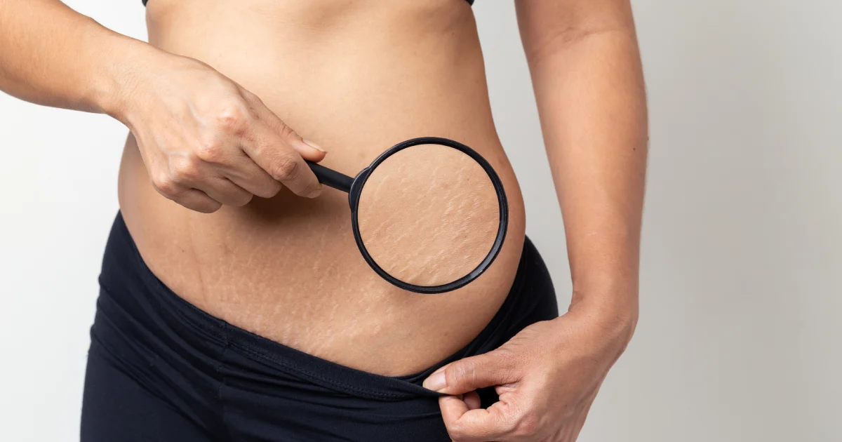 Women receiving Stretch Mark Treatments in Laredo, TX